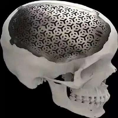 Titan qotishmalari 3D bosilgan tibbiy implantlar